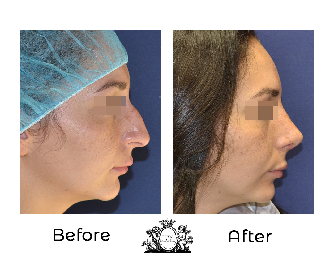 Какво представлява ултразвуковата ринопластика?