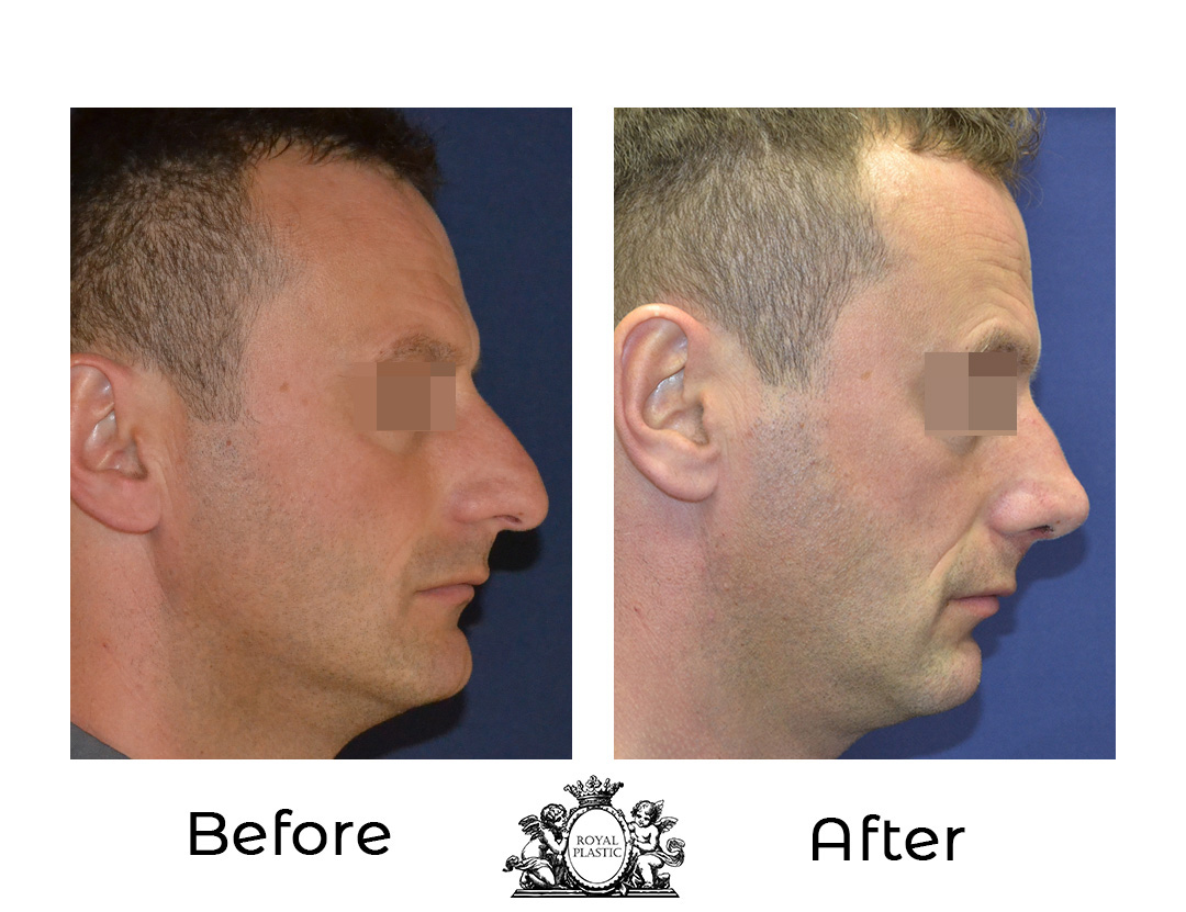 Предимства на ултразвуковата ринопластика