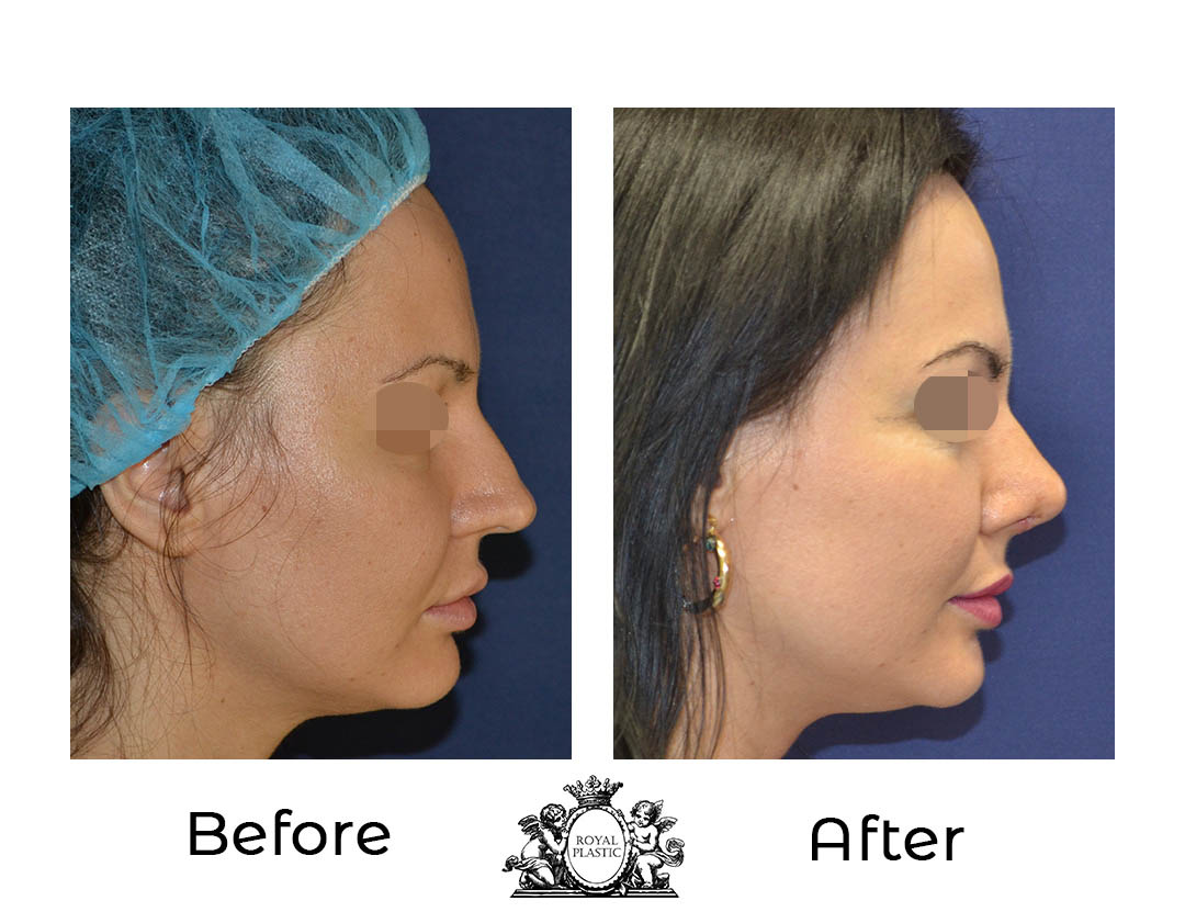 Как протича ултразвуковата ринопластика?