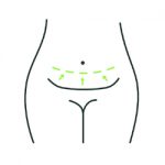 Abdominoplasty